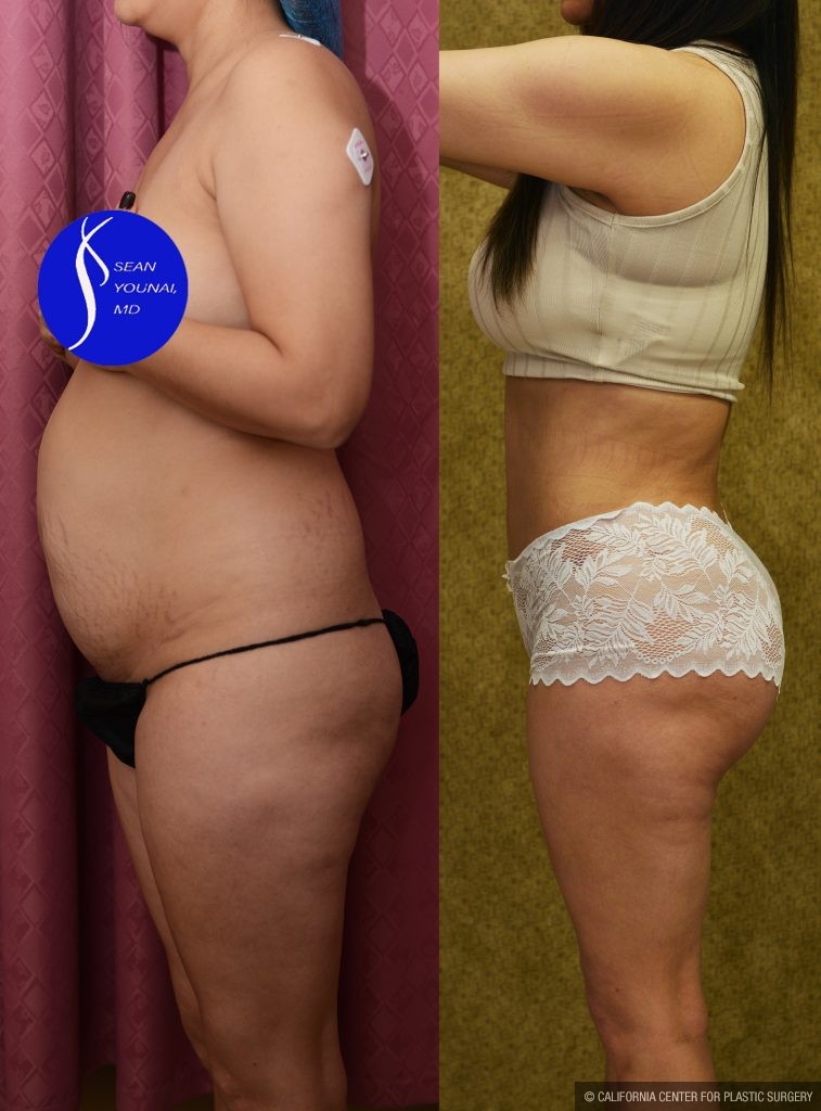Buttock Lift/Augmentation Before & After Patient #14775