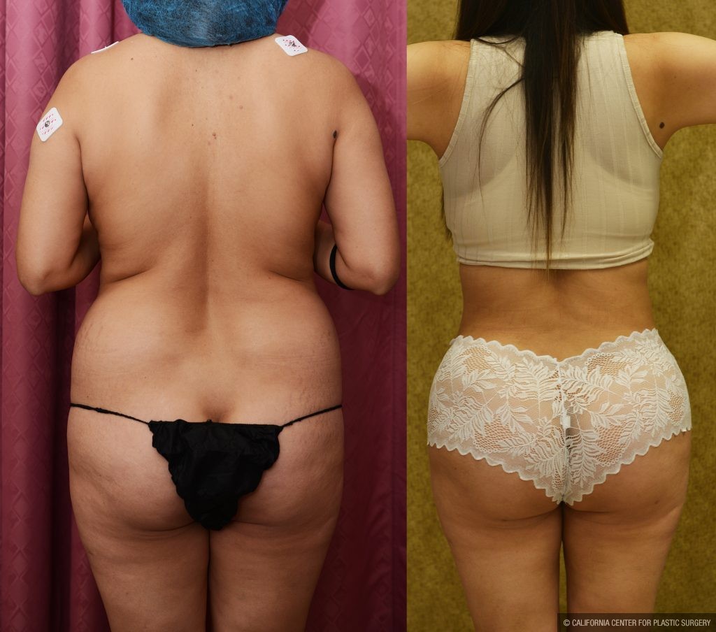 Tummy Tuck (Abdominoplasty) Small Size Before & After Patient #14784