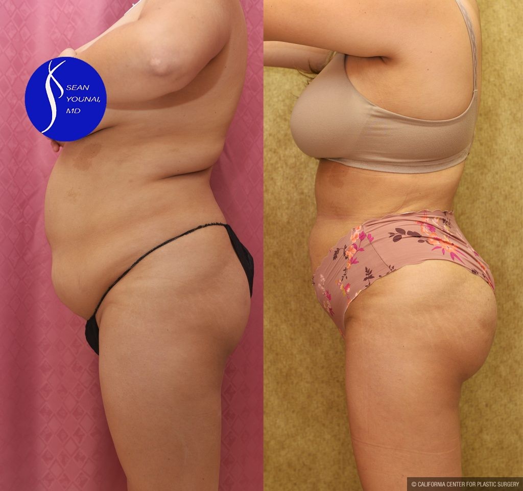 Buttock Lift/Augmentation Before & After Patient #14776