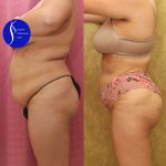 Buttock Lift/Augmentation Before & After Patient #14776