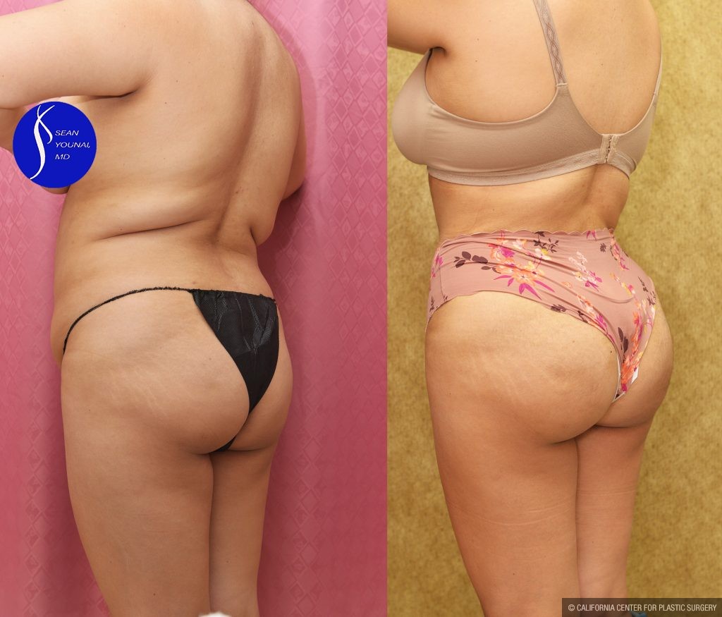 Buttock Lift/Augmentation Before & After Patient #14776