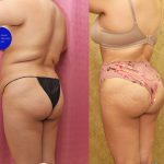 Buttock Lift/Augmentation Before & After Patient #14776