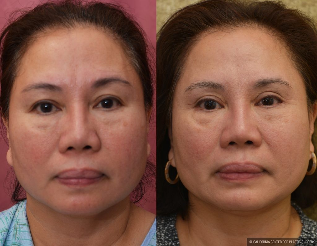 Asian Eyelid Surgery (Blepharoplasty) Before & After Patient #14778