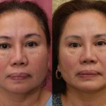 Asian Eyelid Surgery (Blepharoplasty) Before & After Patient #14778