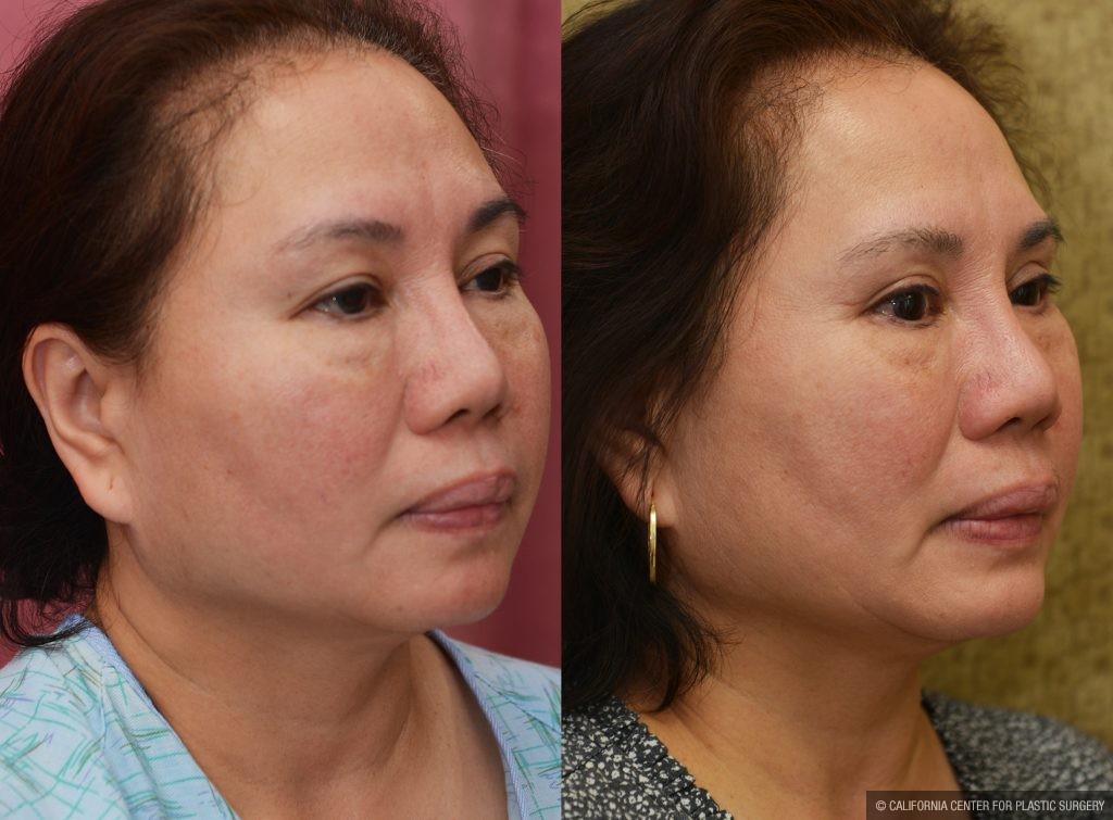Asian Eyelid Surgery (Blepharoplasty) Before & After Patient #14778