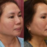 Asian Eyelid Surgery (Blepharoplasty) Before & After Patient #14778