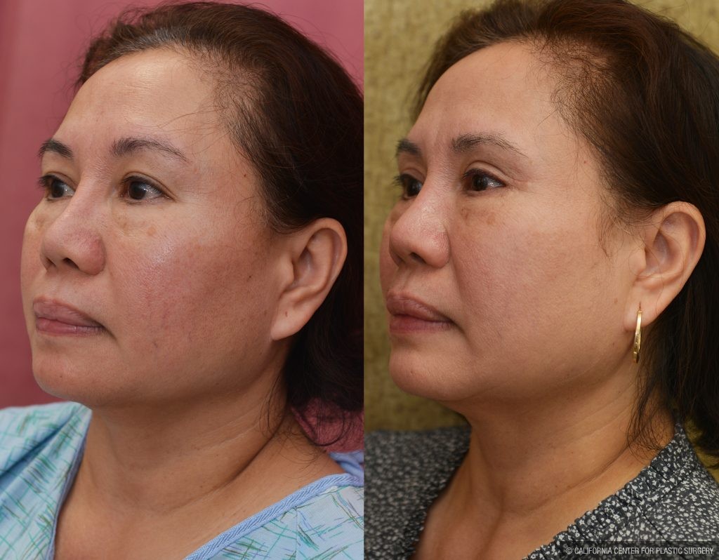 Asian Eyelid Surgery (Blepharoplasty) Before & After Patient #14778