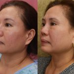 Asian Eyelid Surgery (Blepharoplasty) Before & After Patient #14778
