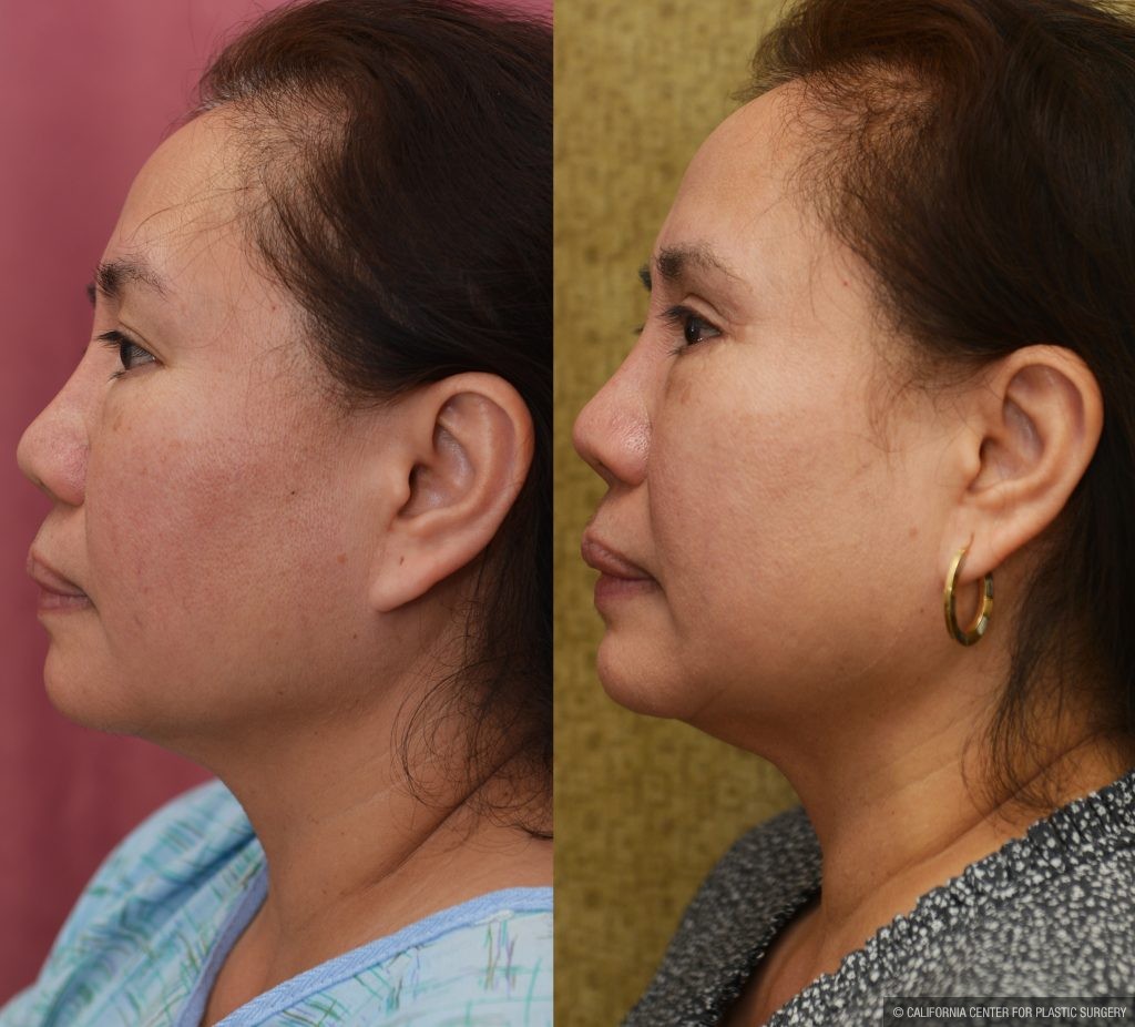 Asian Eyelid Surgery (Blepharoplasty) Before & After Patient #14778