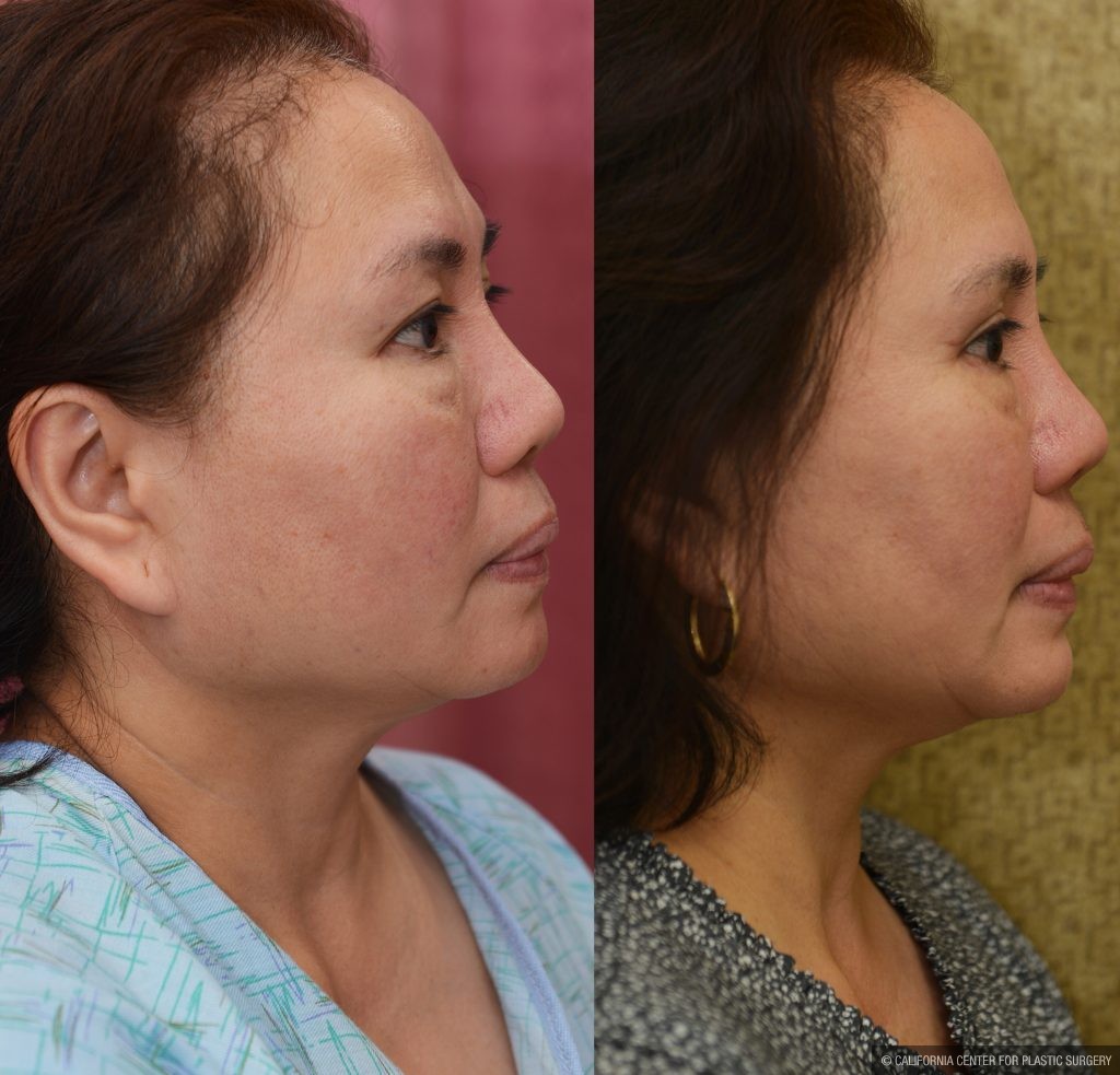 Asian Eyelid Surgery (Blepharoplasty) Before & After Patient #14778