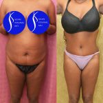 African American Tummy Tuck (Abdominoplasty) Before & After Patient #14779