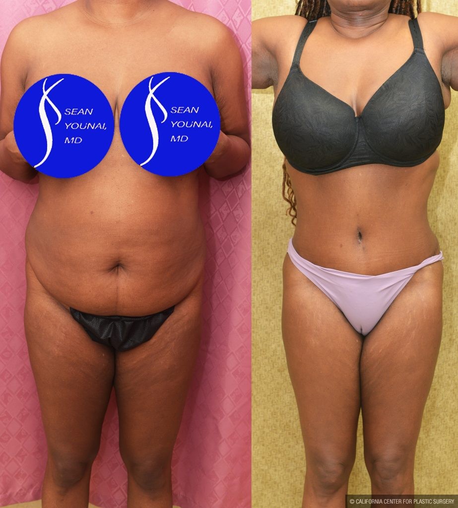 African American Tummy Tuck (Abdominoplasty) Before & After Patient #14779