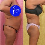 African American Tummy Tuck (Abdominoplasty) Before & After Patient #14779