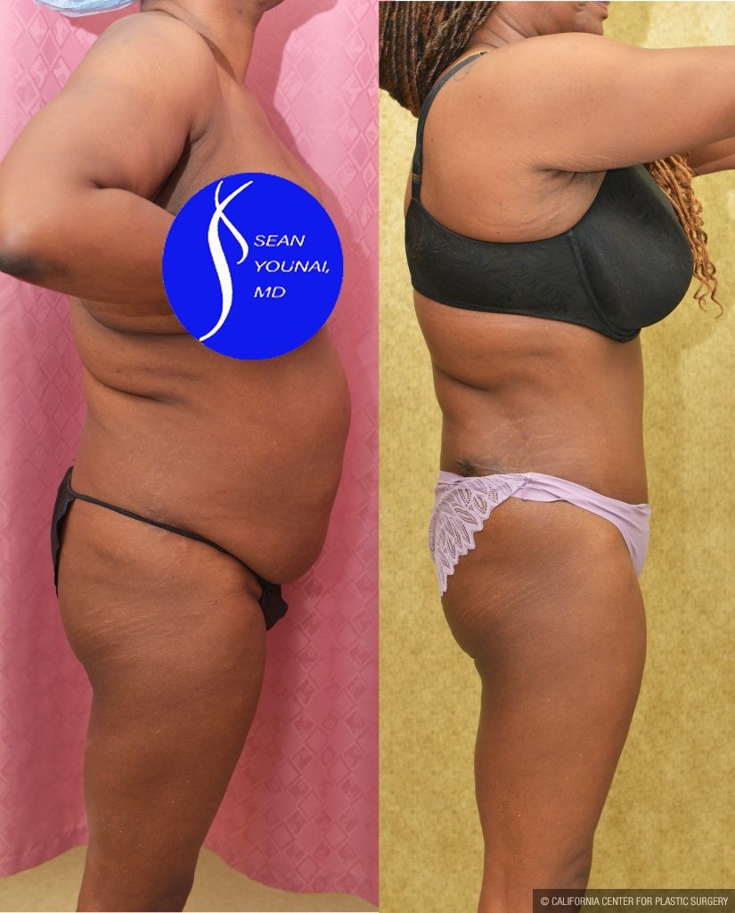 African American Tummy Tuck (Abdominoplasty) Before & After Patient #14779