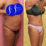 African American Tummy Tuck (Abdominoplasty) Before & After Patient #14779