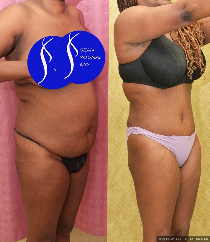 African American Tummy Tuck (Abdominoplasty) Before & After Patient #14779