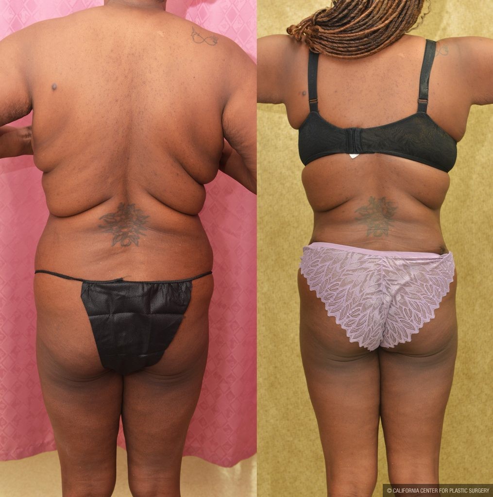 African American Tummy Tuck (Abdominoplasty) Before & After Patient #14779