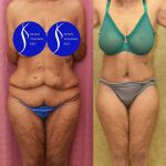 Tummy Tuck (Abdominoplasty) Plus Size Before & After Patient #14781