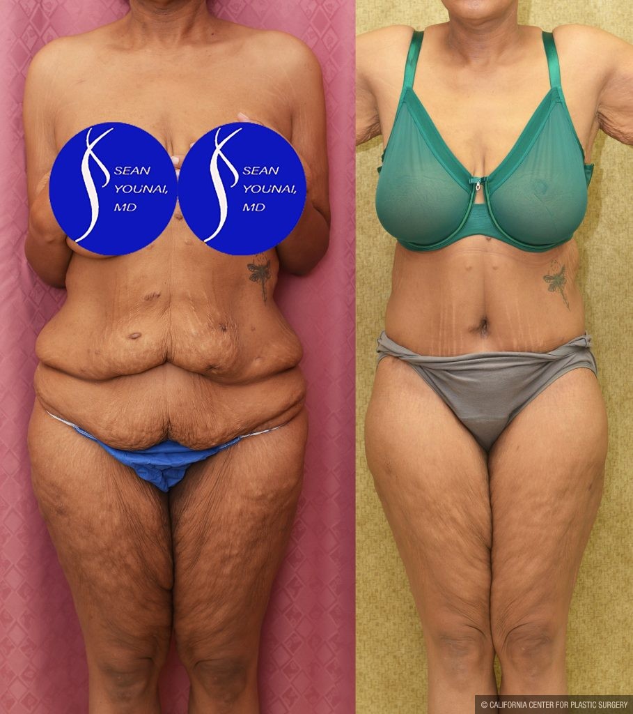 Tummy Tuck (Abdominoplasty) Plus Size Before & After Patient #14781