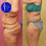 Tummy Tuck (Abdominoplasty) Plus Size Before & After Patient #14781