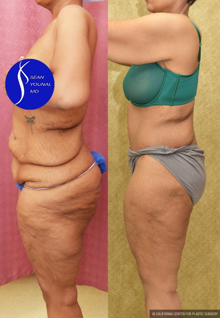 Tummy Tuck (Abdominoplasty) Plus Size Before & After Patient #14781