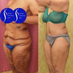 Tummy Tuck (Abdominoplasty) Plus Size Before & After Patient #14781