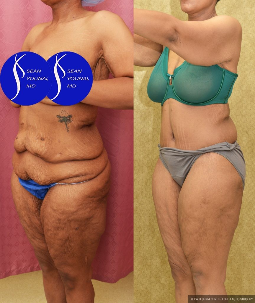 Tummy Tuck (Abdominoplasty) Plus Size Before & After Patient #14781