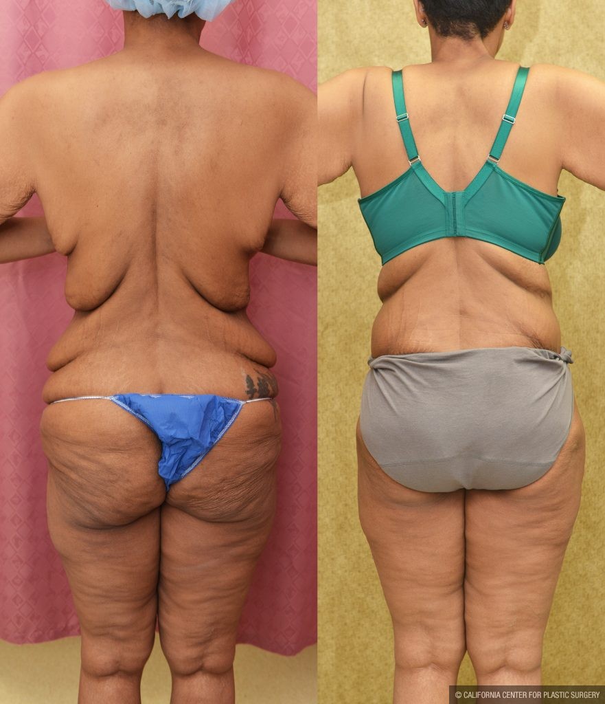 Tummy Tuck (Abdominoplasty) Plus Size Before & After Patient #14781