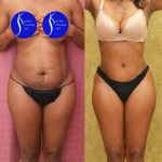 Tummy Tuck (Abdominoplasty) Small Size Before & After Patient #14782