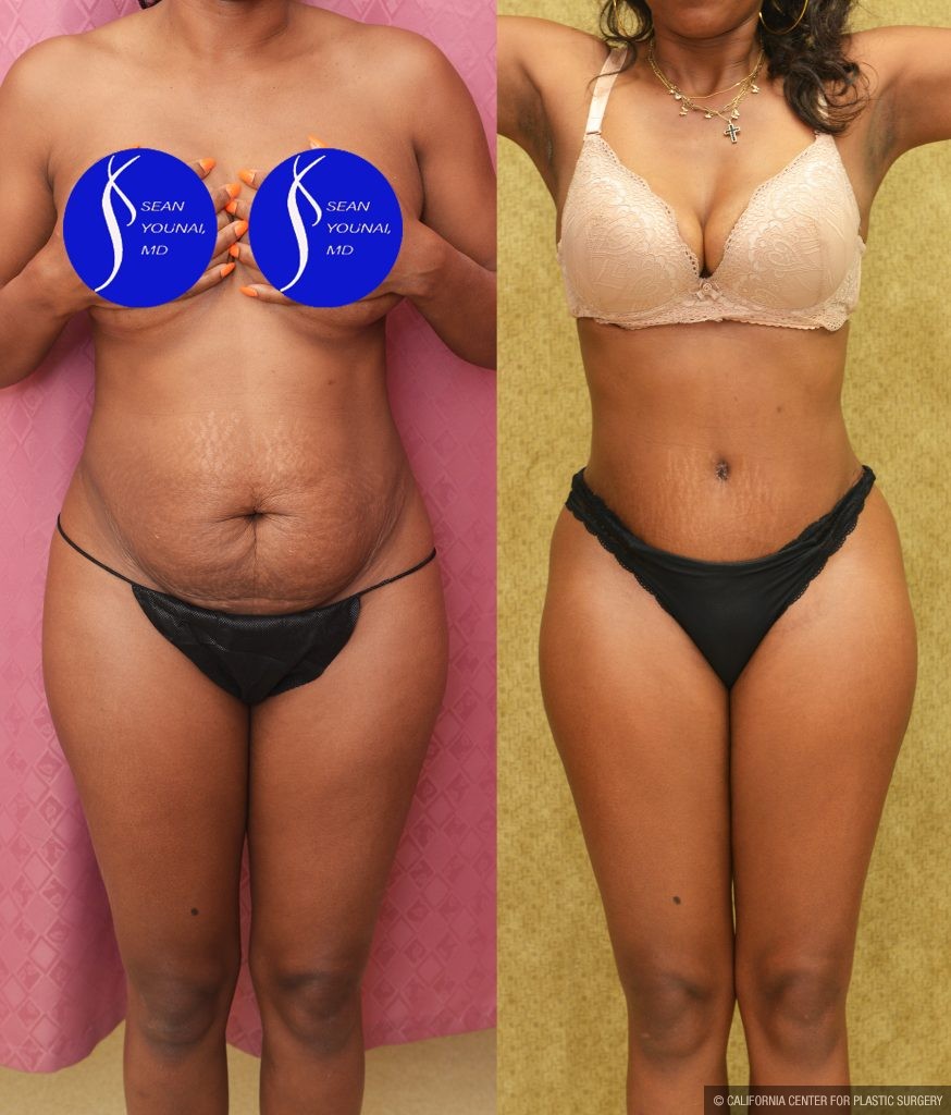 Tummy Tuck (Abdominoplasty) Small Size Before & After Patient #14782
