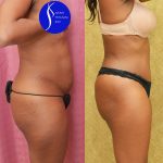 Tummy Tuck (Abdominoplasty) Small Size Before & After Patient #14782