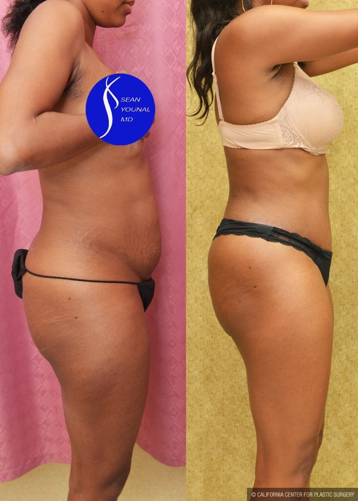 African American Tummy Tuck (Abdominoplasty) Before & After Patient #14780