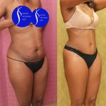 Tummy Tuck (Abdominoplasty) Small Size Before & After Patient #14782