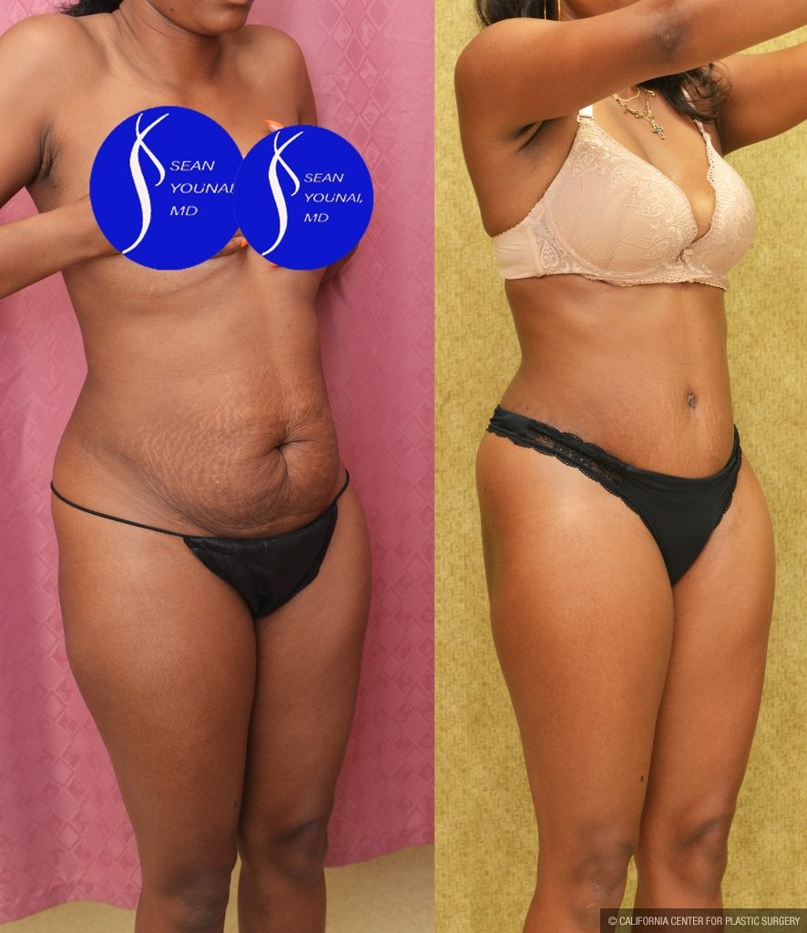 Tummy Tuck (Abdominoplasty) Small Size Before & After Patient #14782