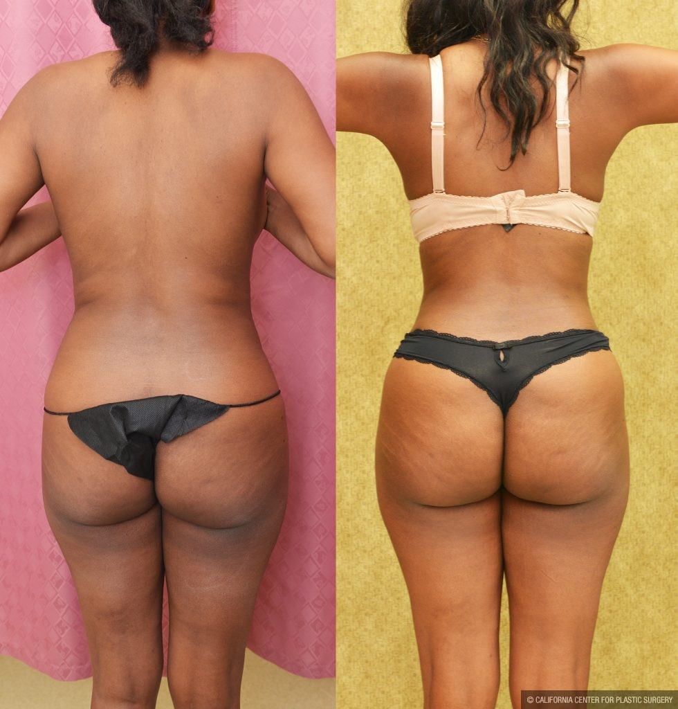 African American Tummy Tuck (Abdominoplasty) Before & After Patient #14780