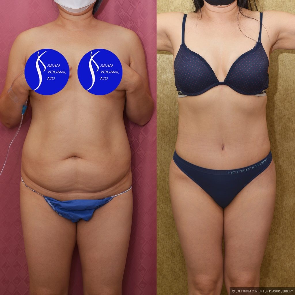 Tummy Tuck (Abdominoplasty) Small Size Before & After Patient #14783