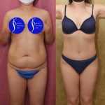 Tummy Tuck (Abdominoplasty) Small Size Before & After Patient #14783