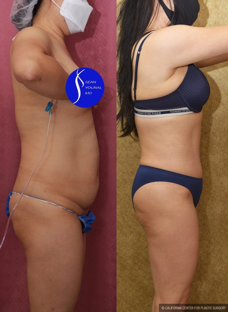 Tummy Tuck (Abdominoplasty) Small Size Before & After Patient #14783