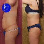 Tummy Tuck (Abdominoplasty) Small Size Before & After Patient #14783