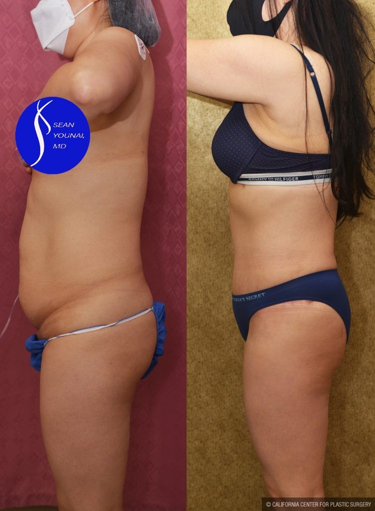 Tummy Tuck (Abdominoplasty) Small Size Before & After Patient #14783