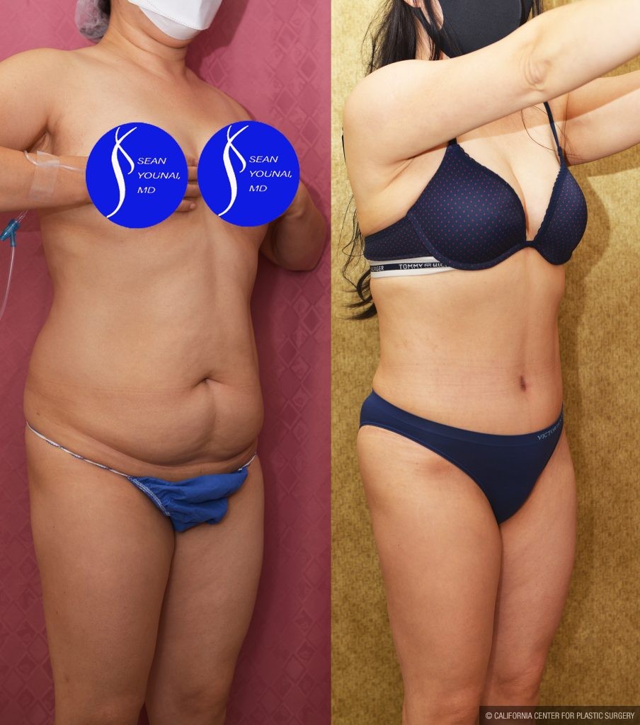Tummy Tuck (Abdominoplasty) Small Size Before & After Patient #14783