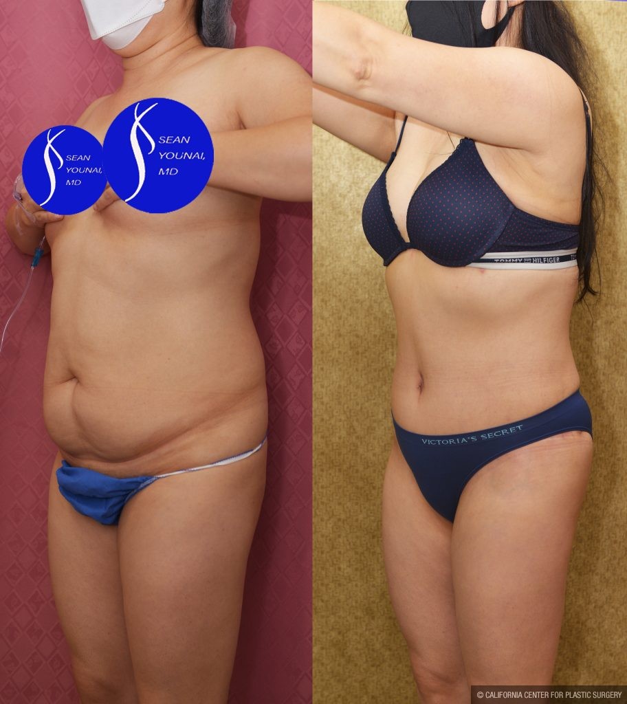 Tummy Tuck (Abdominoplasty) Small Size Before & After Patient #14783