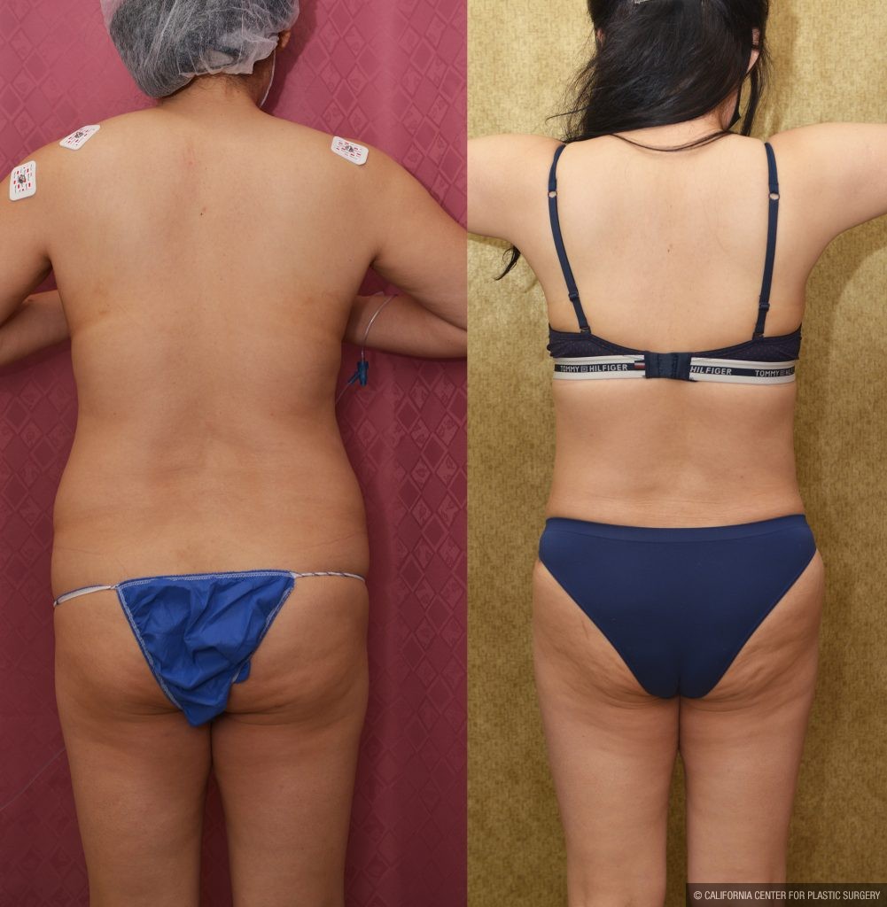 Tummy Tuck (Abdominoplasty) Small Size Before & After Patient #14783