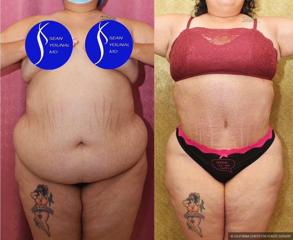 Tummy Tuck (Abdominoplasty) Super Plus Size Before & After Patient #14785