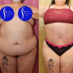 Tummy Tuck (Abdominoplasty) Super Plus Size Before & After Patient #14785