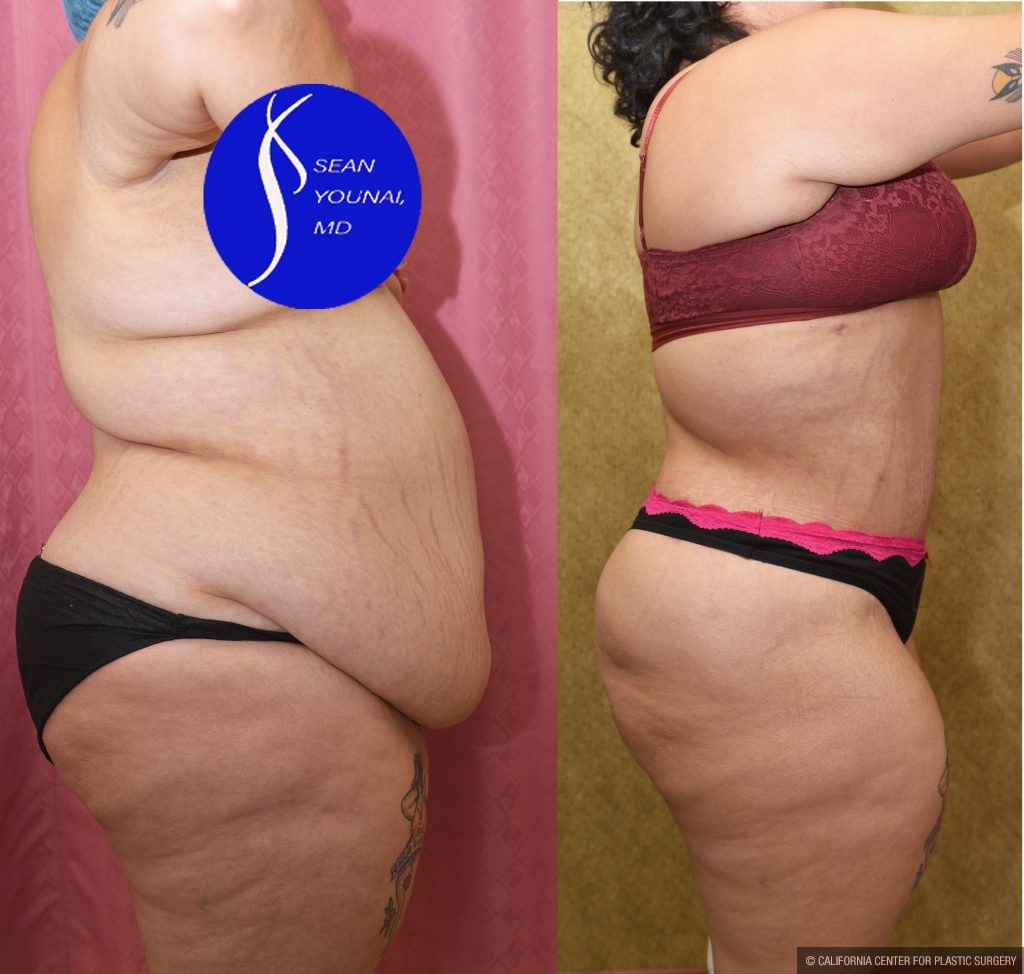Tummy Tuck (Abdominoplasty) Super Plus Size Before & After Patient #14785