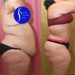 Tummy Tuck (Abdominoplasty) Super Plus Size Before & After Patient #14785