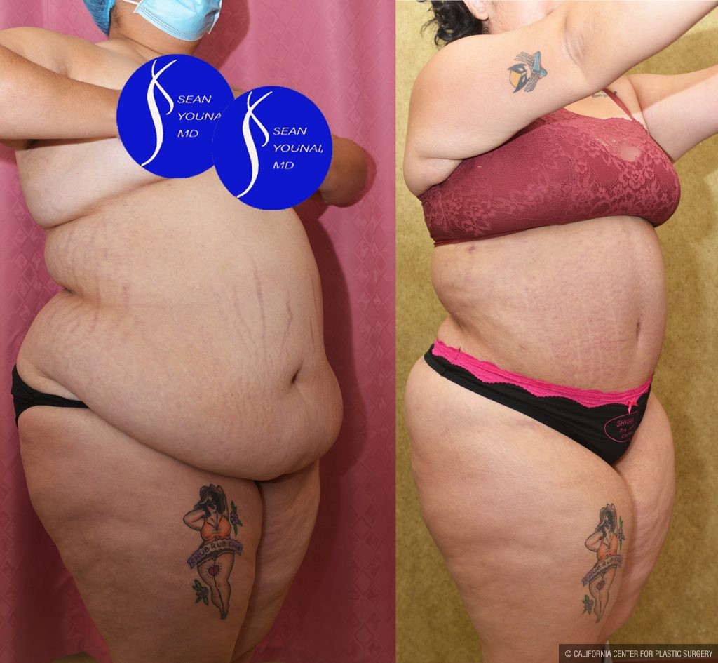 Tummy Tuck (Abdominoplasty) Super Plus Size Before & After Patient #14785