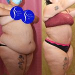 Tummy Tuck (Abdominoplasty) Super Plus Size Before & After Patient #14785