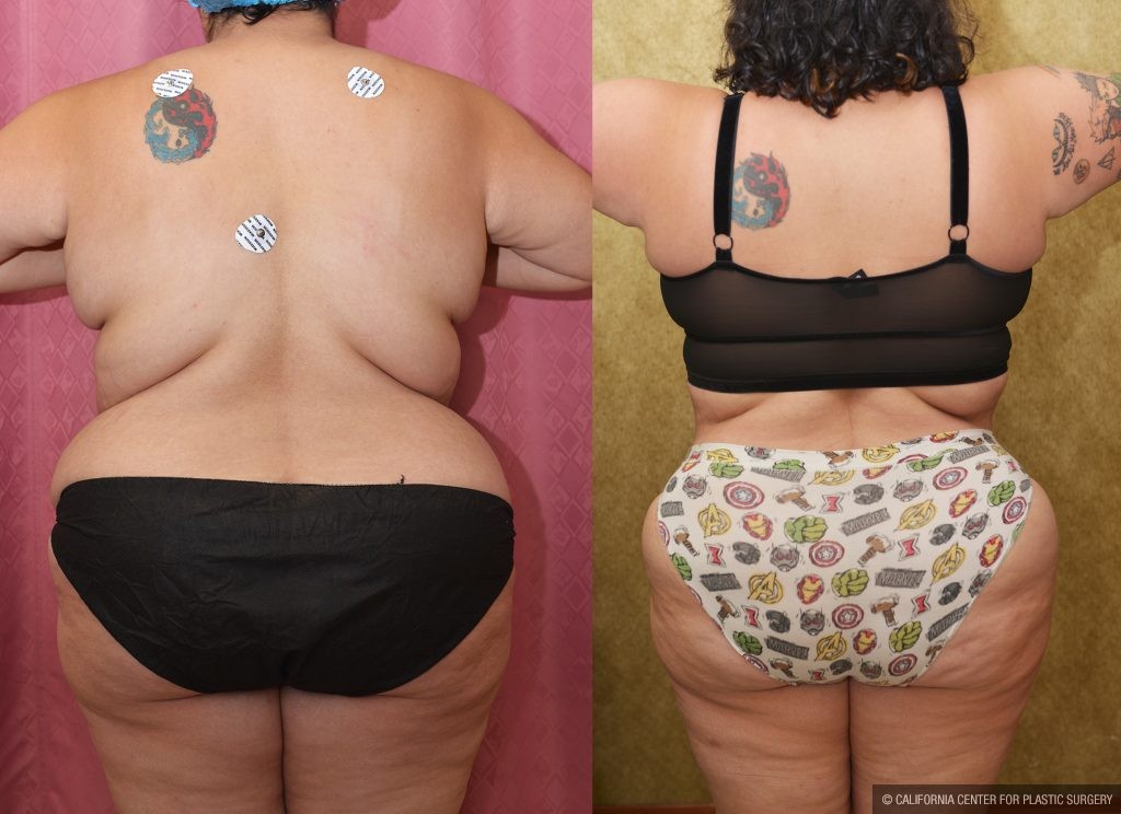 Tummy Tuck (Abdominoplasty) Super Plus Size Before & After Patient #14785